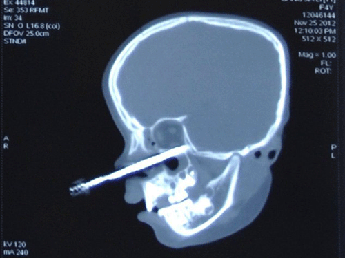 Hình ảnh chụp chiếc tuốc-nơ-vít trong mũi